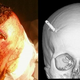 Illustration for article titled This Man Had a Taser Dart Stuck In His Brain and Didnt Even Realize